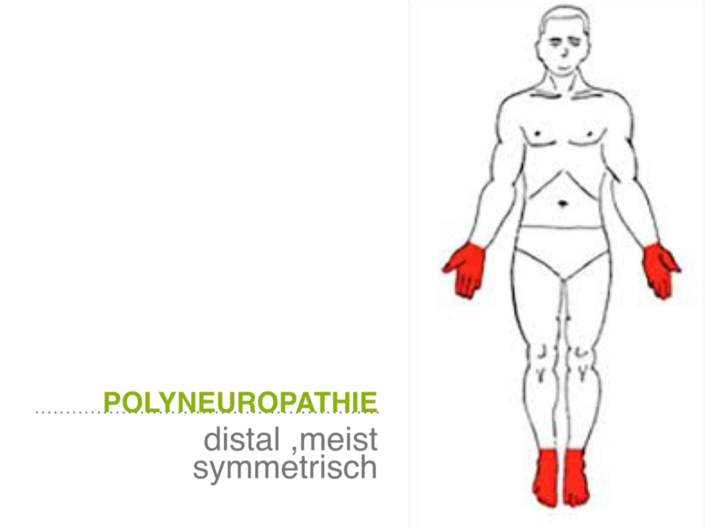 Grafische Darstellung eines Menschen mit rot markierten Stellen, wo Polyneuropathie sich ausbreiten kann.