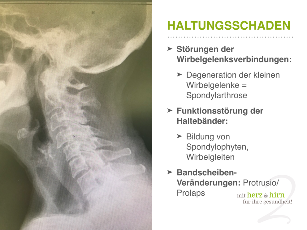 Ein Röntgenbild von einem Hals von der Seite und nebenbei stehen Informationen zum Thema Haltungsschaden.